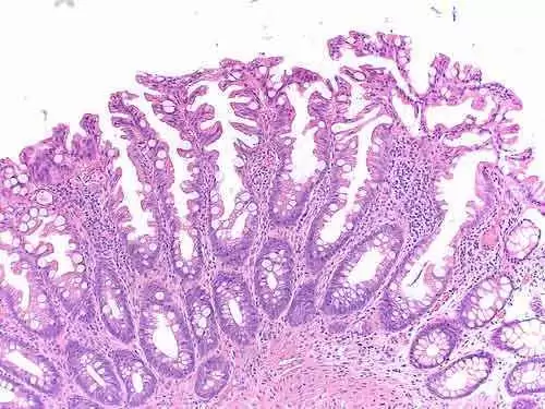 Patchy Villous Atrophy and Celiac Disease