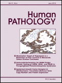 Enteropathy-associated T-cell Lymphoma: A Clinicopathologic and Array Comparative Genomic Hybridization Study - Human Pathology