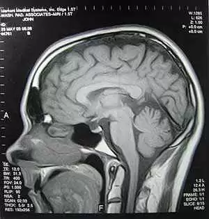 Brain Abnormalities in Patients with Celiac Disease and Neurological Issues