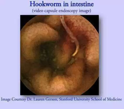 Have Celiac Disease? Try a Little Hookworm with that Pasta! - Photo: CC--SuSanA Secretariat