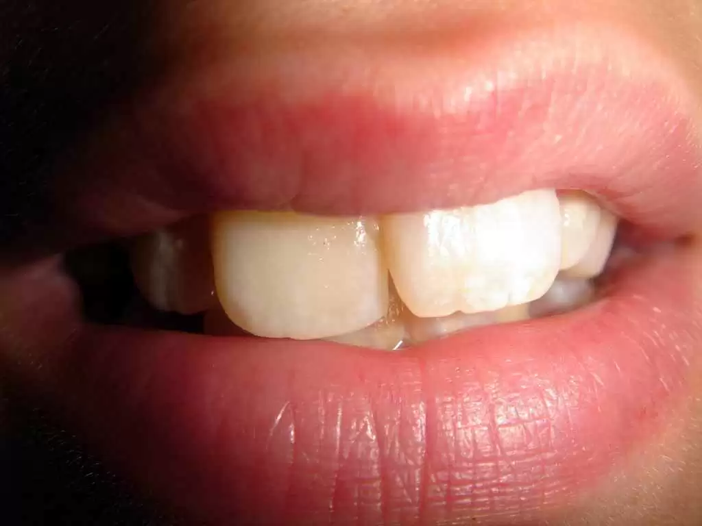 Distinct Tooth Enamel Defects Can Help Reveal Celiac Disease