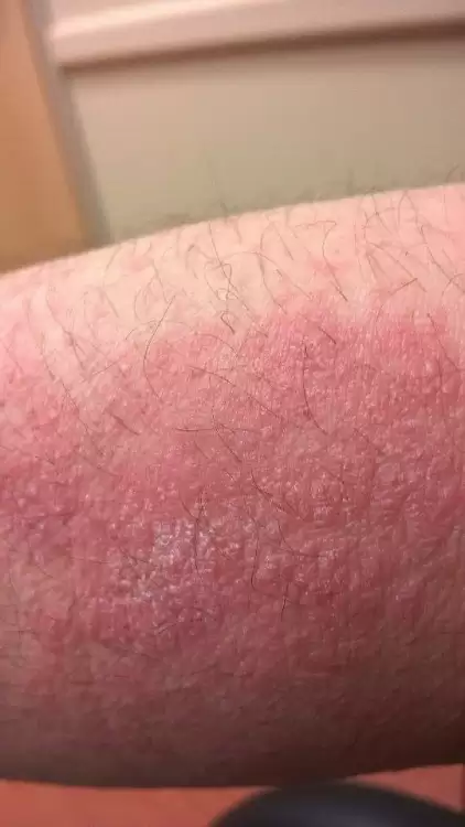 Very Itchy Rash!! Possible DH - Celiac.com