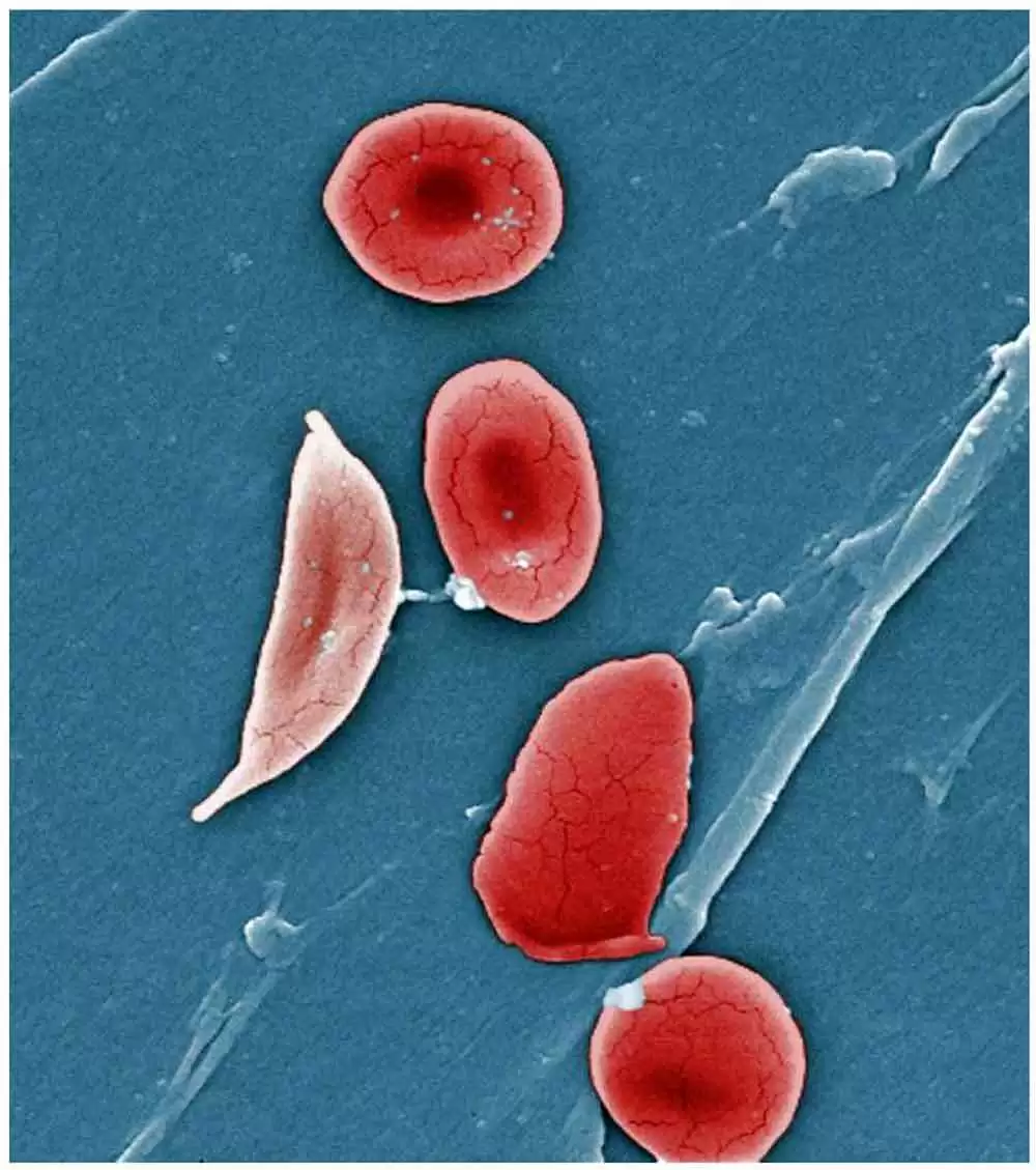 Sickle Cell Disease - Image: CC--OpenStax College - Anatomy & Physiology, Connexions Web site.