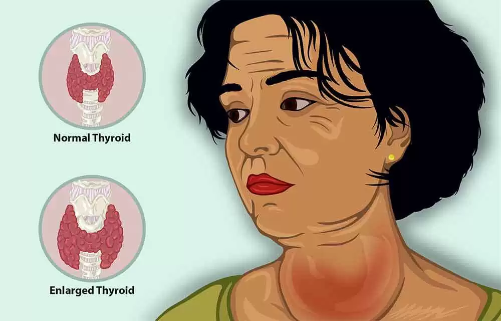 Gluten and Your Thyroid