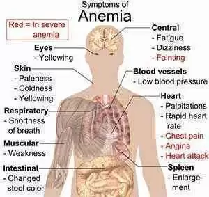 Celiac Disease Common in Cases of Unexplained Nutritional Anemia