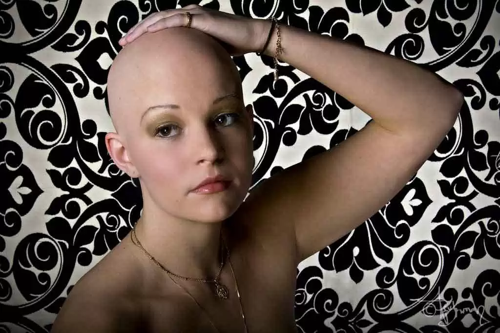 More information about "Alopecia in Women Linked to Autoimmune Disease, Thyroid Problems"