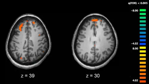 Exploring Links Between Autoimmune Diseases and Schizophrenia (+Video) - Schizophrenia fMRI working memory by Kim J, Matthews NL, Park S. is licensed under CC BY 2.5.++ Watch the Video ++