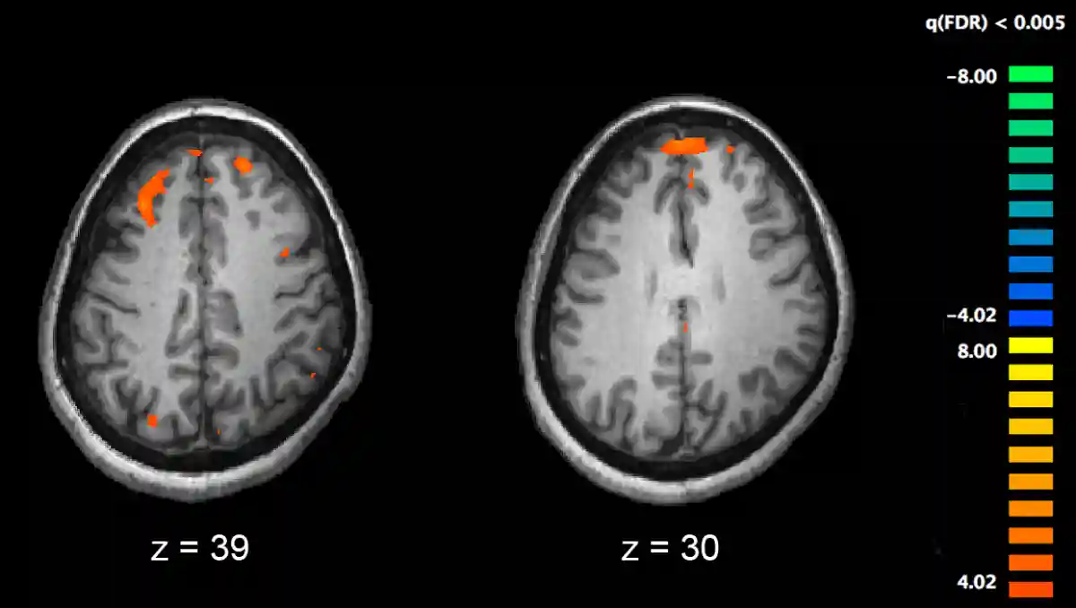 More information about "Exploring Links Between Autoimmune Diseases and Schizophrenia (+Video)"