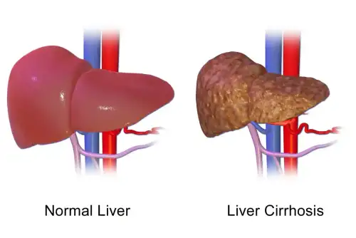 The Long-term Risk of Chronic Liver Disease in Celiac Disease Patients - Liver Cirrhosis by BruceBlaus is licensed under CC BY-SA 4.0.