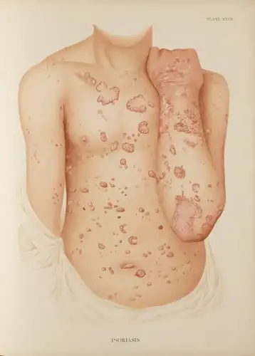 The Connection Between Celiac Disease and Skin Conditions: What You Need to Know - File: Plate XXIII, Psoriasis. Crocker 1896 Wellcome L0074325 is licensed under CC BY 4.0.